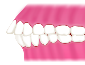 Maxillary prognathism