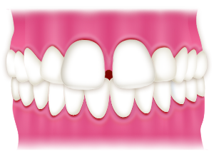 Gap teeth