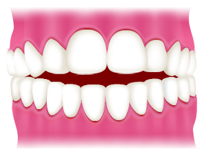 Open bite