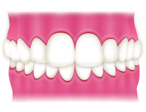 Over bite