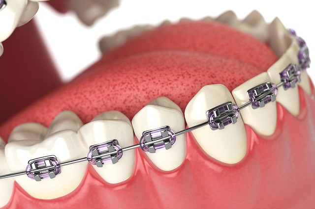 wire orthodontics
